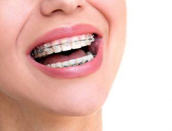 Align Your Teeth with Appropriate Braces