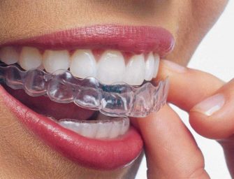 Start Smiling Confidently Through Invisalign Aligners Today